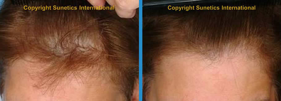 Female, 62 years old -After 6 Months