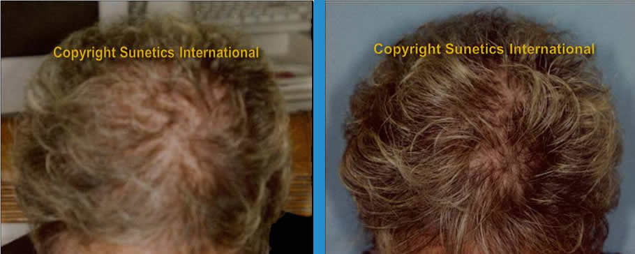 Female, 51 years old -After 6 Months