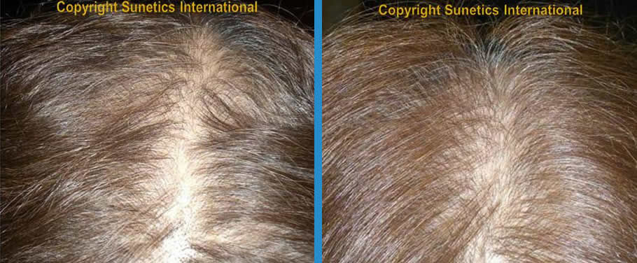 Female, 60 years old -After 6 Months