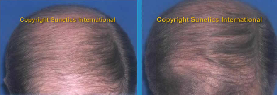 Male, 58 years old - After 6 Months