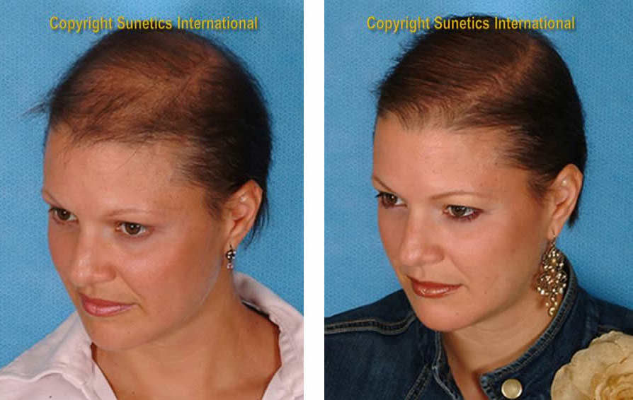 Female, 39 years old -After 4 Months