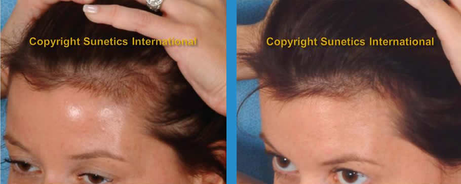 Female, 30 years old-After 12 Months