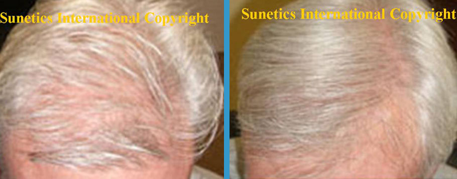 Male, 55 years old - After 6 Months