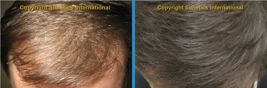 Male, 26 years old - After 12 Months
