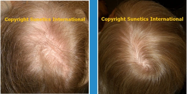 Female, 59 years old –After 6 Months