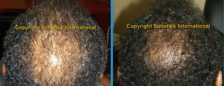 Male, 49 years old - After 3 Months
