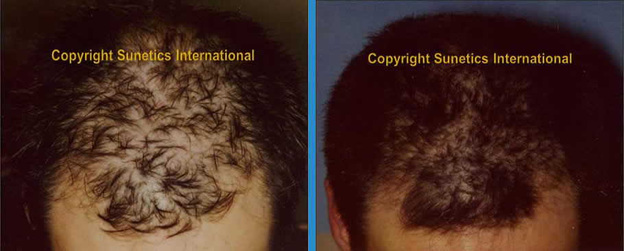 Male, 25 years old - After 6 Months