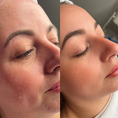 No Needle Skin Booster amazing before and after results