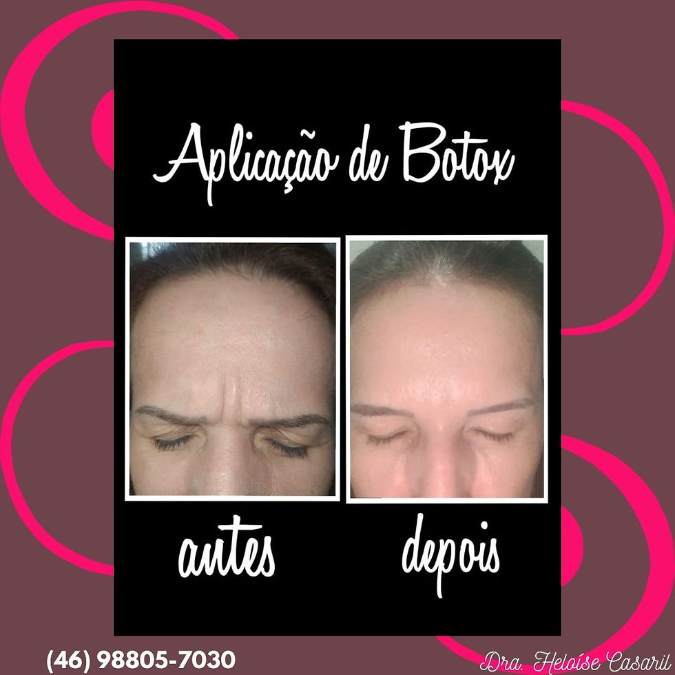 Botox Facial