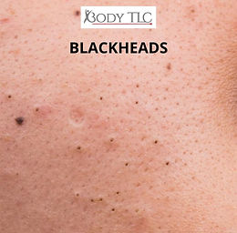 BLACKHEADS.jpg