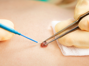 Advanced Electrolysis