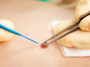 Advanced Electrolysis