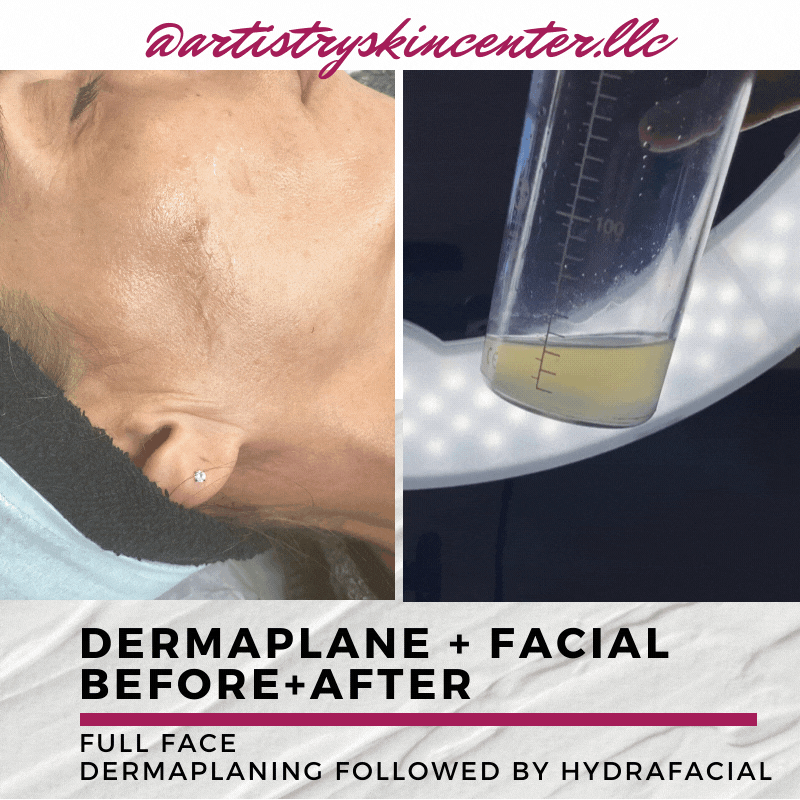 Dermaplane+Hydrafacial BA