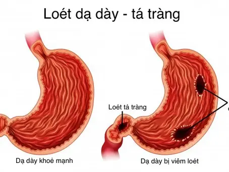 Chữa trị Viêm loét dạ dày – tá tràng theo phương pháp Đông Y
