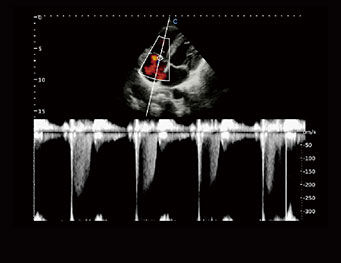 TV，Regurgitação，Modo C
