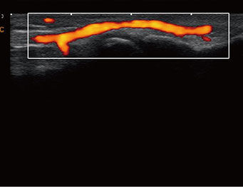 Vaso Superficial Profundidade de 0,2 cm, Modo CPA