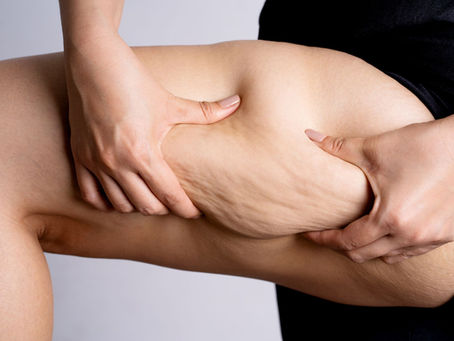 Cellulite: understanding and caring for orange-peel skin