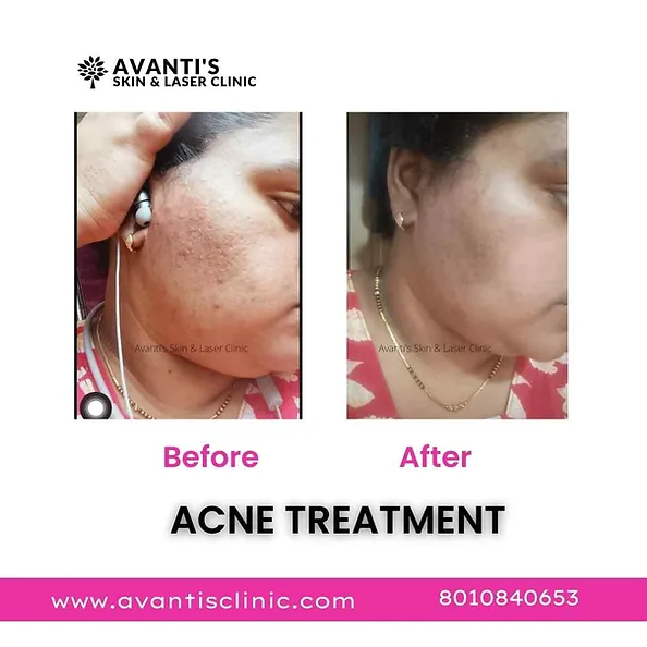 acne-treatment2.webp