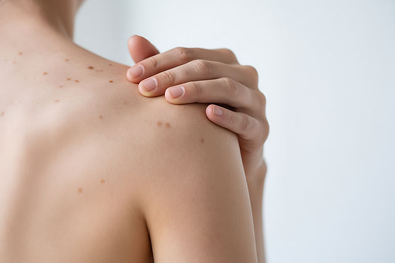 Huidtumoren verwijderen Plastische Chirurgie Jacobs