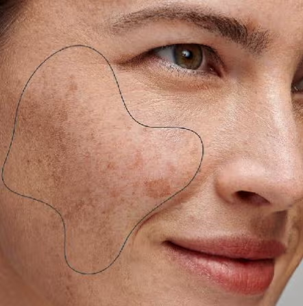 Pigmentation: September10 Salon