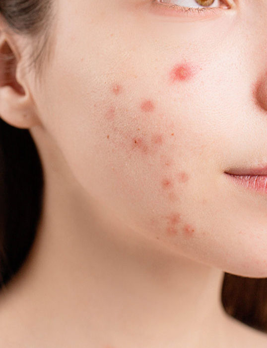Acne & Treatment Options: September10 Salon