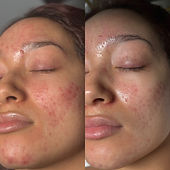 Acne Facial 
