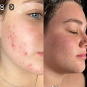 Acne Treatments 