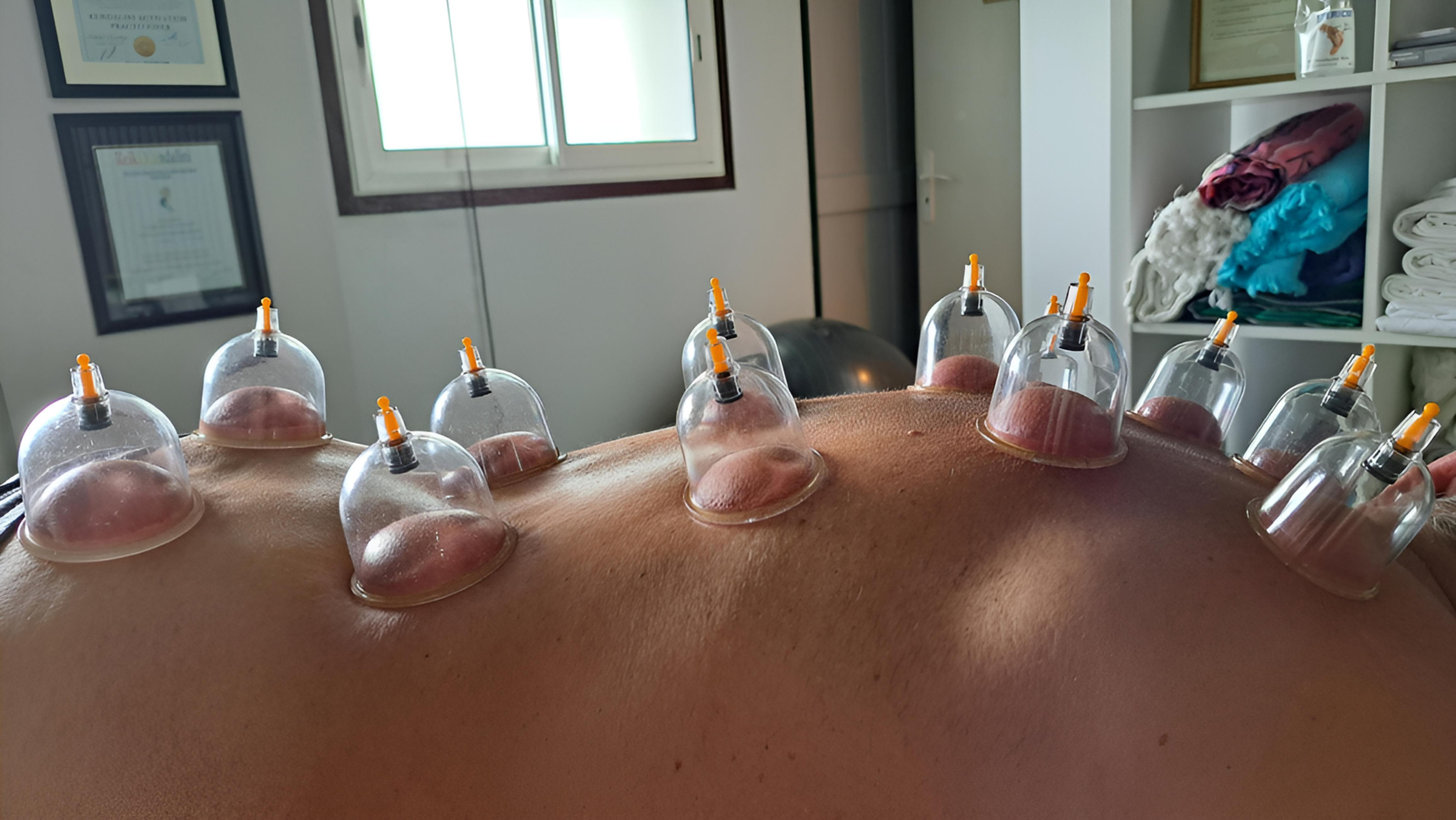 Cupping St Barth