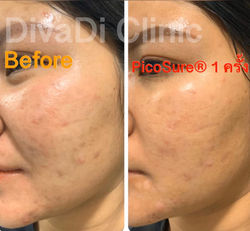 picosure เลเซอร์ รีวิว รักษา รอยดำสิว_2.
