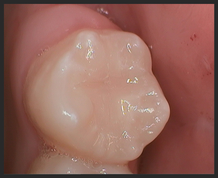 Fissure Sealants