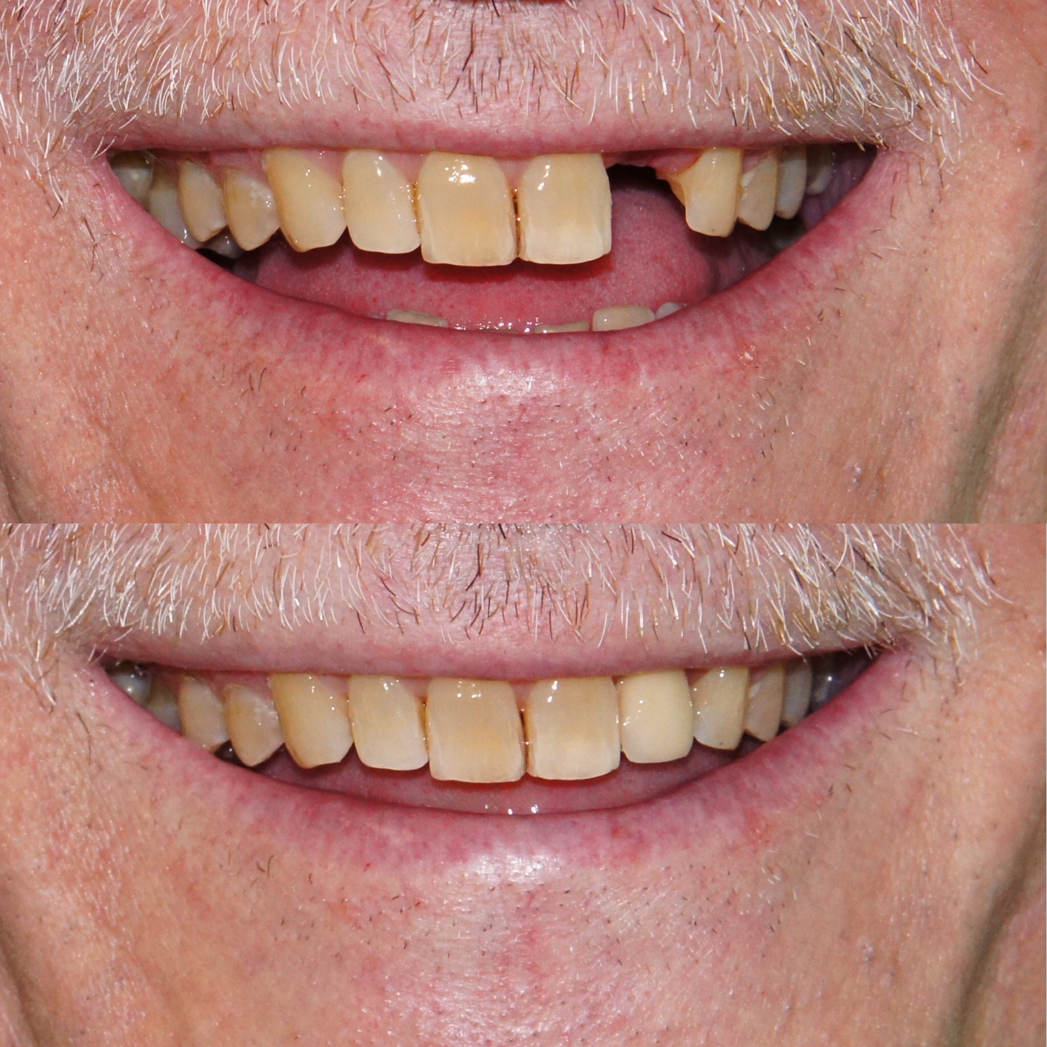 zoom teeth whitening reviews 2015 zoom teeth whitening reviews 2015