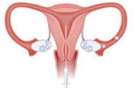 IUI by Dr. Harshita Pandey