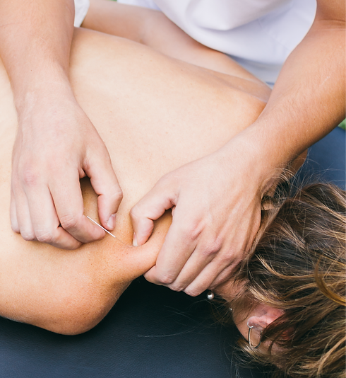 Dry needling the shoulder_edited.png
