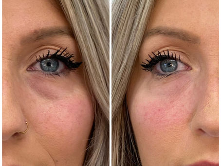 Tear Trough (Undereye) Filler to Refresh dark circles and tired-looking eyes.
