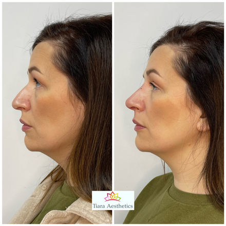 Nose reshape