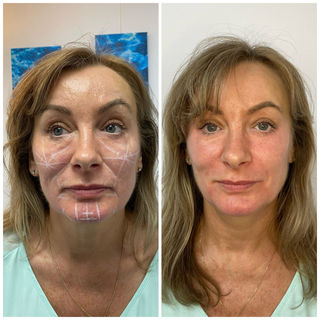 Chin and Jawline transformation