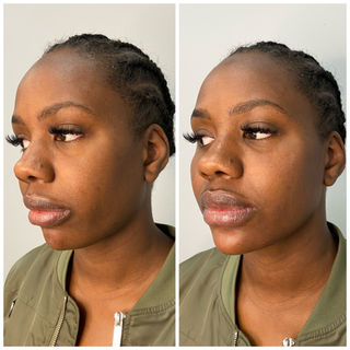 Chin and Jawline transformation