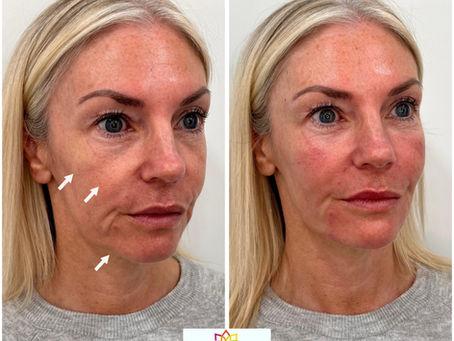 Which Cosmetic Injectable Refresh Package is Right for You?