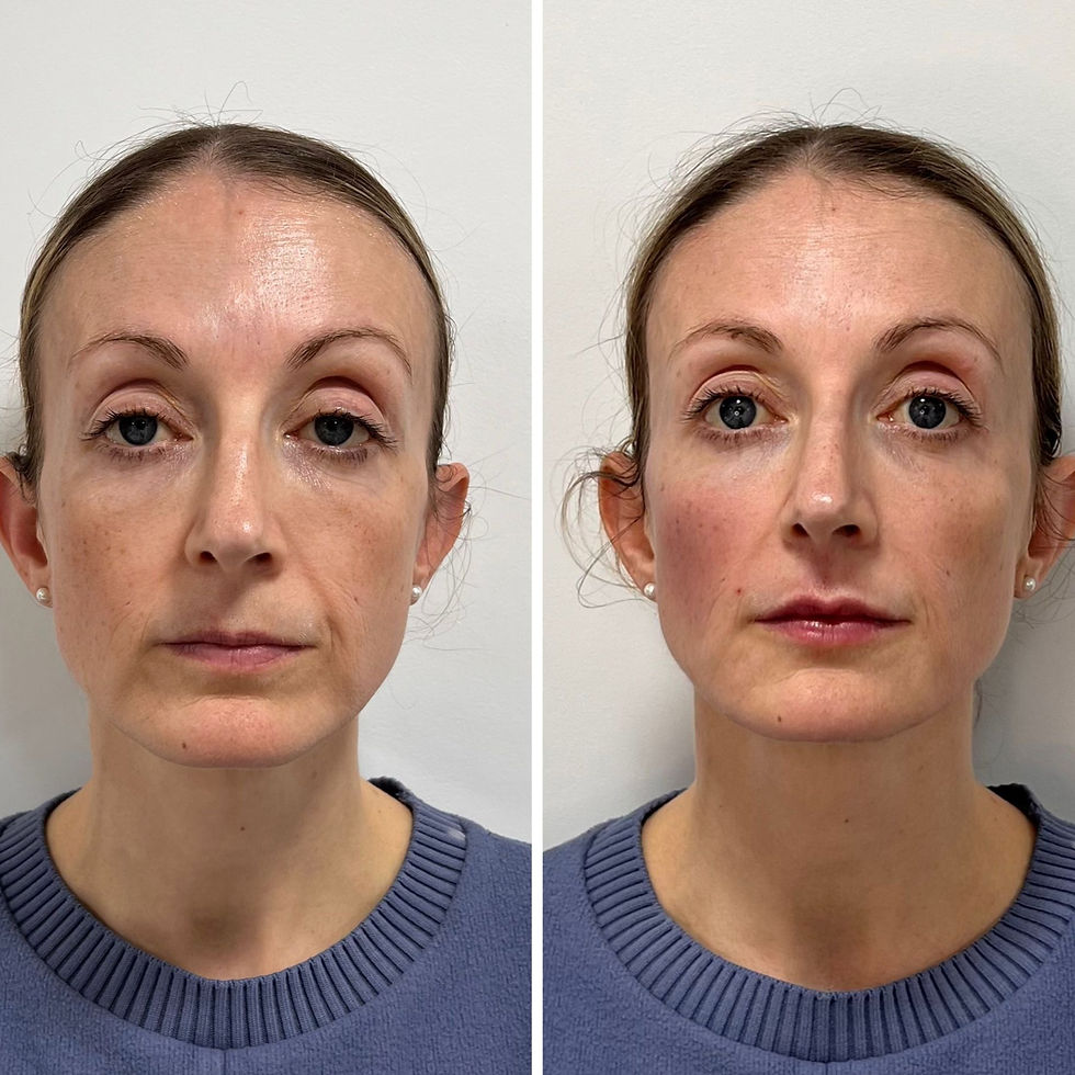 Natural lip fillers Midlands – subtle lip enhancement