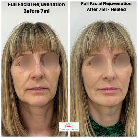 Cheek Augmentation
Birmingham&Leicester