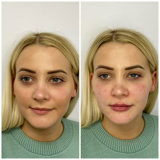 Birmingham&Leicester
Lip enhancement