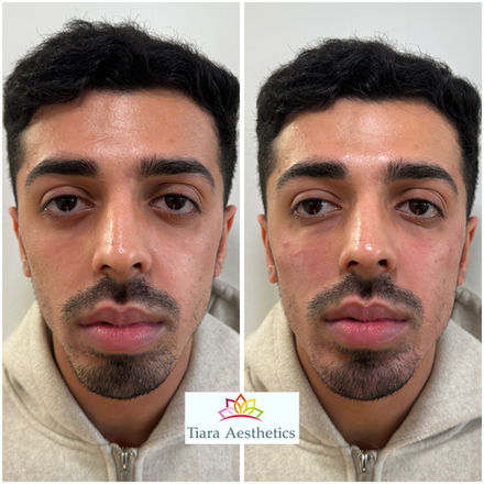 Tear Trough Treatment
Birmingham&Leicester