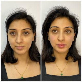 Birmingham&Leicester
Lip enhancement