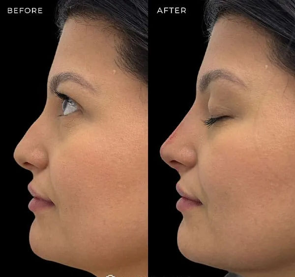 non-surgical-nose-job-12-3_edited