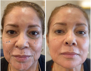 dermal fillers training