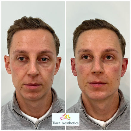 Tear Trough Treatment
Birmingham&Leicester