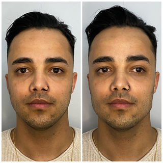 Chin and Jawline transformation