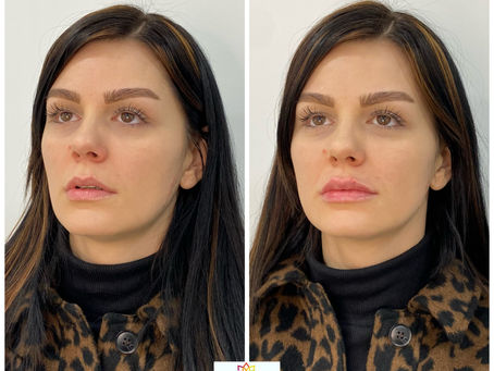 What causes the "duck effect" in lips and how to avoid it?