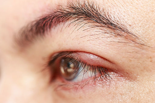 pink eye