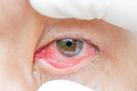Pink Eye